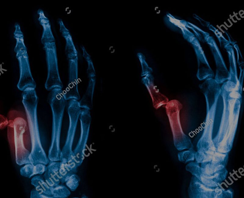 Broches pour extrémités