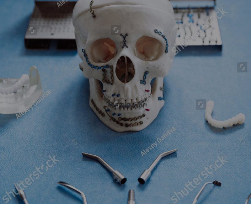 Plaques maxilo-faciales