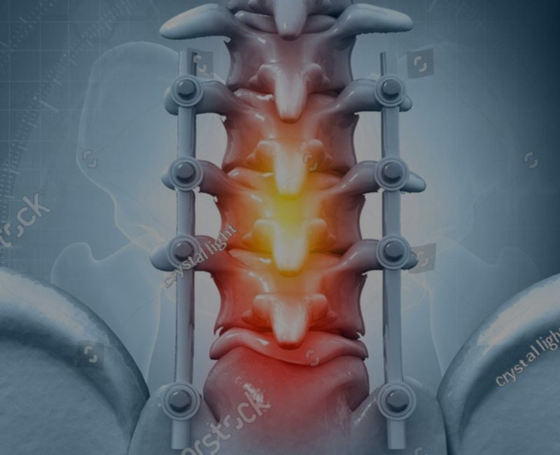 Chirurgie rachidienne