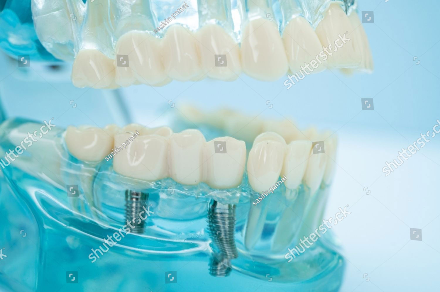 stock-photo-dental-implant-artificial-tooth-roots-into-jaw-root-canal-of-dental-treatment-gum-disease-teeth-2510800179